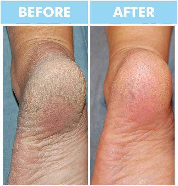 BODIPURE Keratin Hand Foot Mask 6+6 Deep Moisturizing for Dry Skin Callus