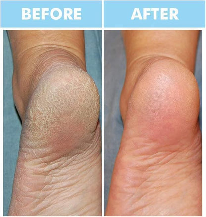 BODIPURE Keratin Hand Foot Mask 6+6 Deep Moisturizing for Dry Skin Callus