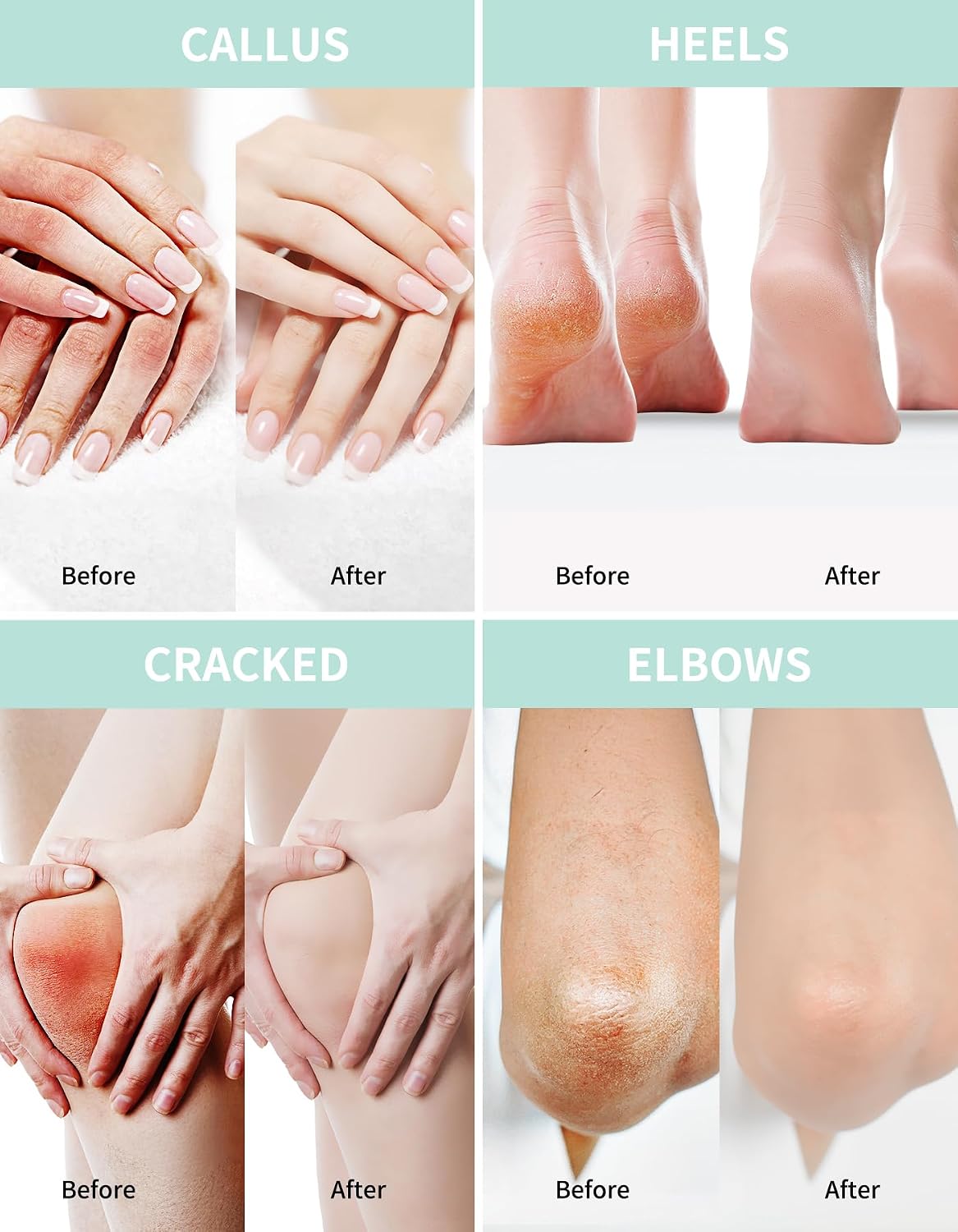 Grocerism Urea Cream 40% for Feet Maximum Strength Hand & Foot Cream 5.29oz
