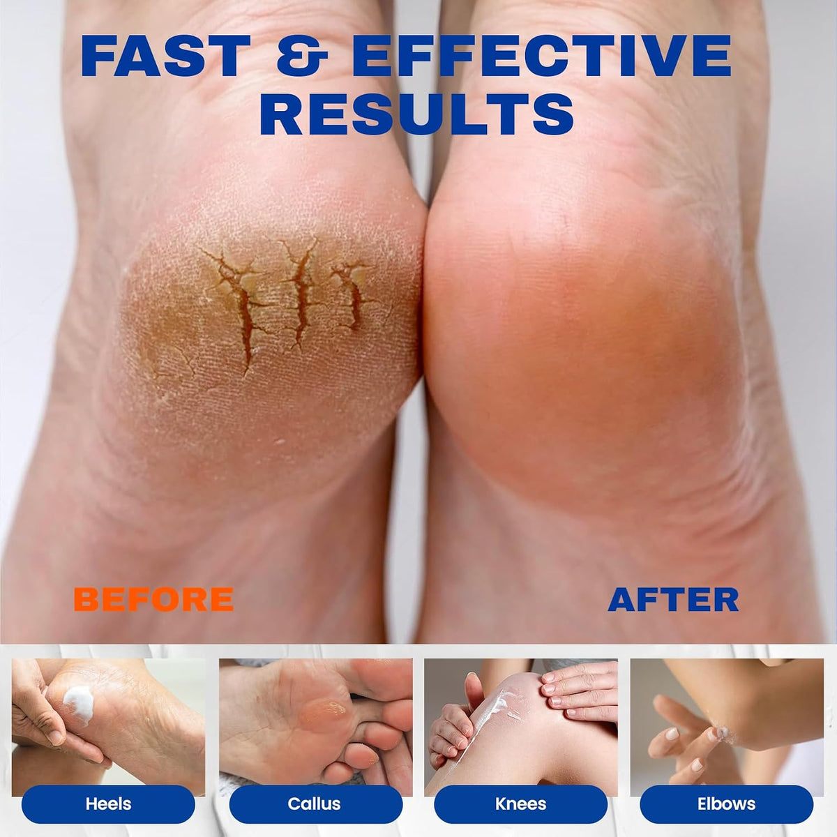 Urea Cream 40 Percent Plus 2% Salicylic Acid for Feet Maximum Strength