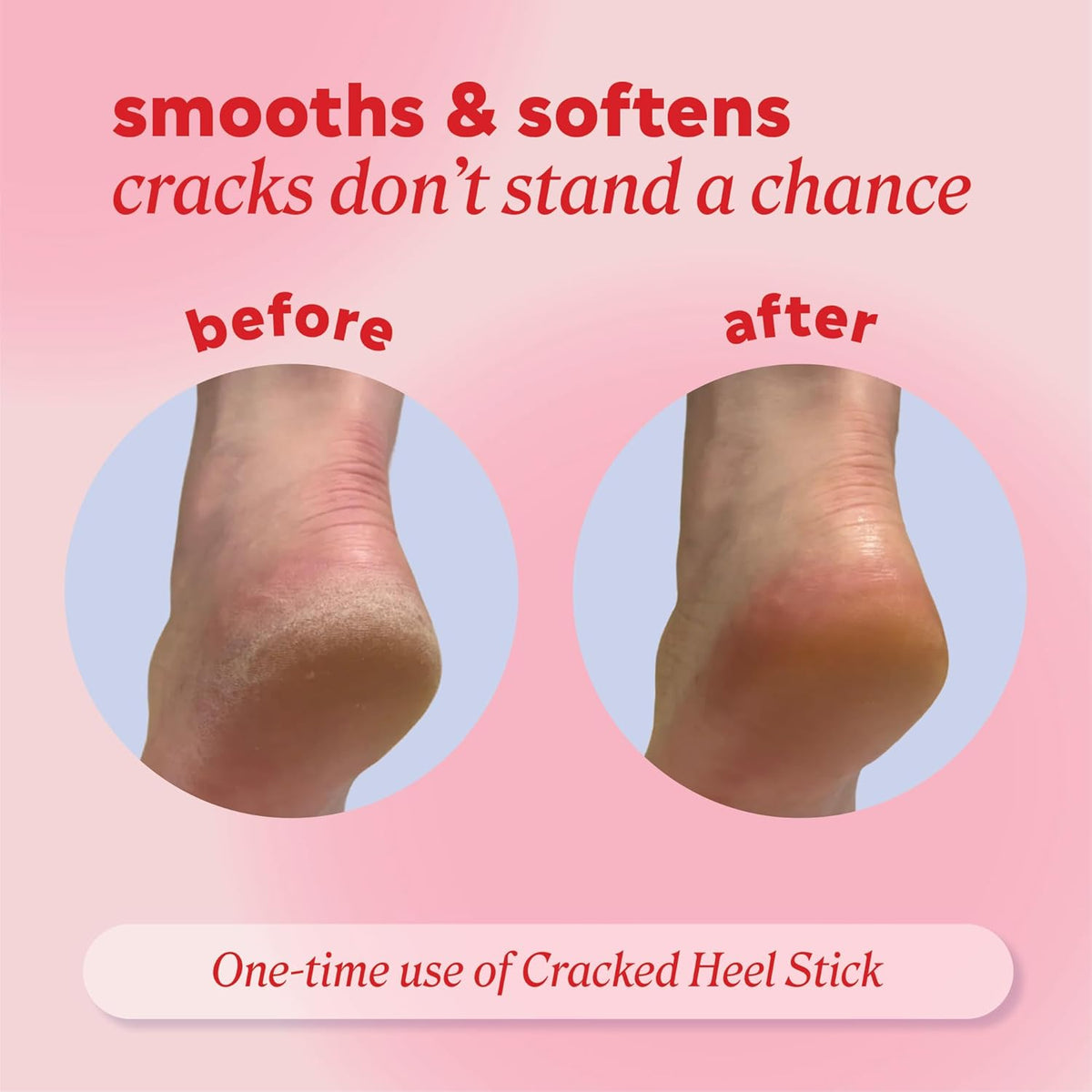 Onyx Professional Cracked Heel Treatment, Repairs Dry Heels, Coconut, 1 pk