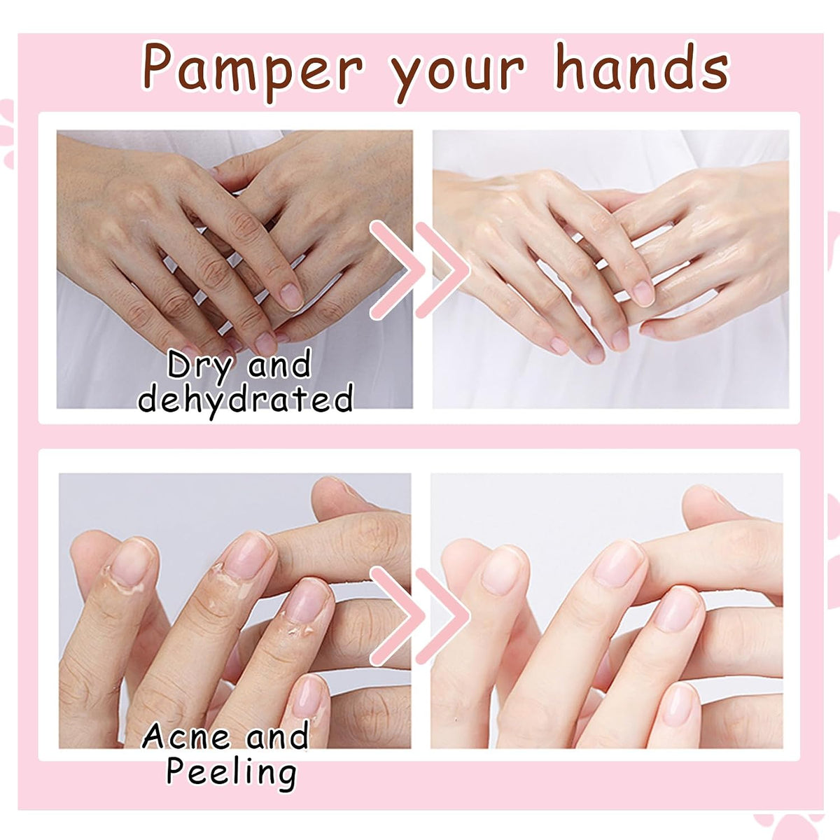 Hand Masks, 6 Pairs Hydrating Exfoliating Hand Peeling Mask, Smooth Hand Masks Moisturizing Gloves Overnight for Dry, Rough, Cracked Hands, Hand Skin Moisturizer Glove for Women Men（A