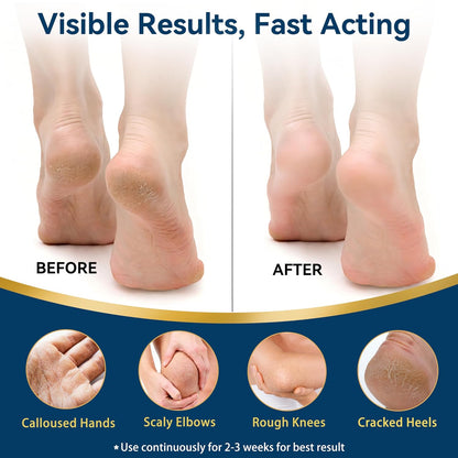 40% Urea Cream with 2% Salicylic Acid, Maximum Strength Foot Hand Cream, Intensive Repair Moisturizer for Dry Cracked Heels Knees Elbows, Exfoliating Callus Remover for Rough Thick Skin
